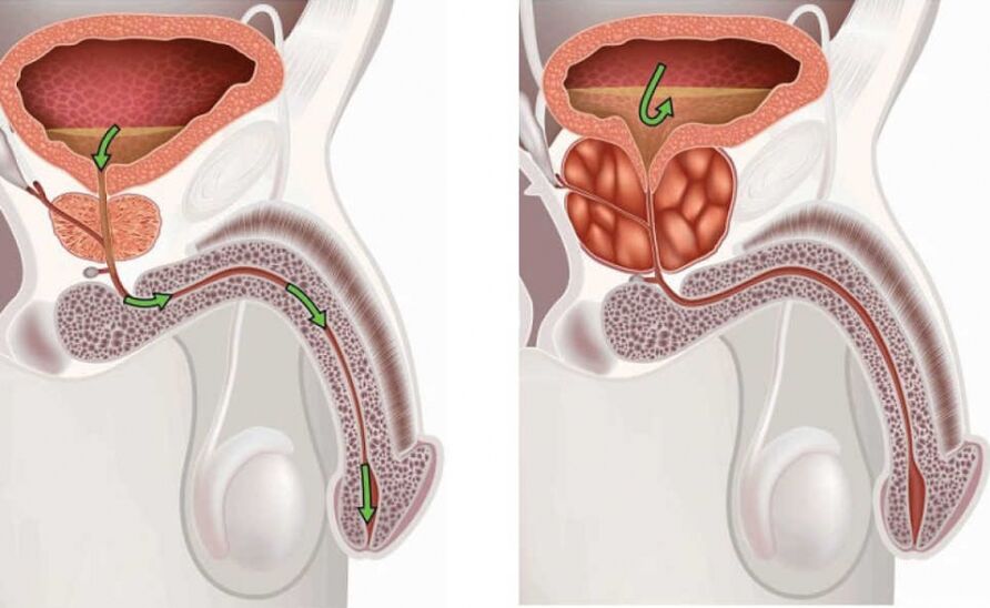 Información sobre a enfermidade da prostatite